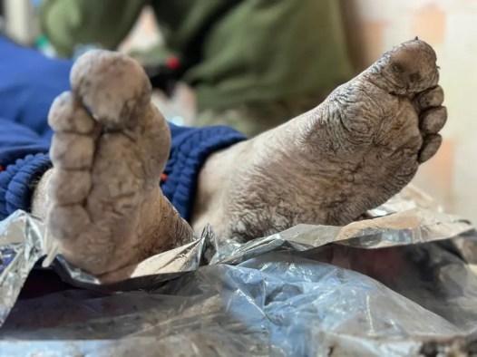 Окопная болезнь Фото Алина Михайлова